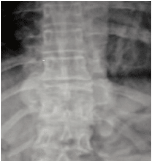 Lateral spine X-ray with a flattened T10 vertebral body and normal disc spaces above and below.