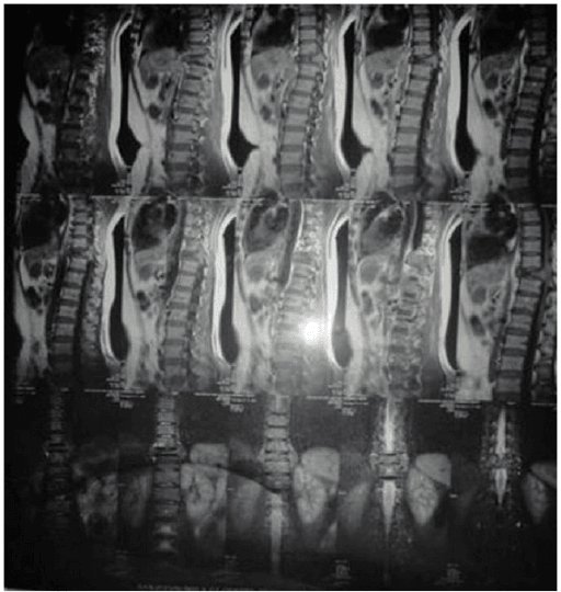 Sagittal MRI of dorsolumbar spine with marrow replacement of a vertebra and posterior elements plus enhancing paravertebral soft tissue.