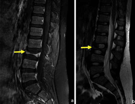 Sagittal T1 and T2 MRI of the spine showing a flattened vertebral body with intact end plates, discs and posterior elements.