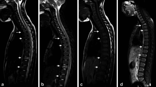 Four sagittal MRI sequences of a child's spine in Langerhans cell histiocytosis.