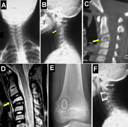 Cervical spine X-rays, sagittal CT reformat and sagittal T2 MRI showing partial collapse of the C3 vertebral body and loss of lordosis.