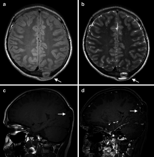 Axial and sagittal MRI of the skull showing a lesion in a teenage boy with Langerhans cell histiocytosis.