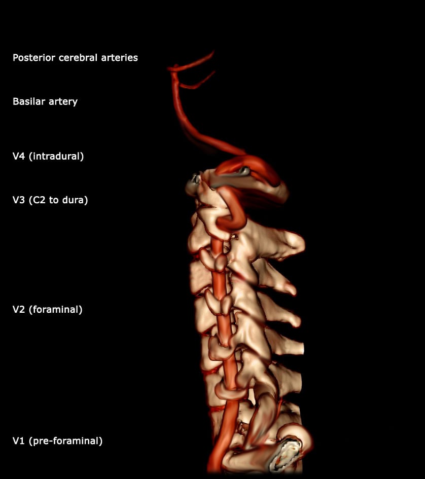 3D CT angiogram of the vertebral artery showing segments V1 to V4 joining the basilar artery