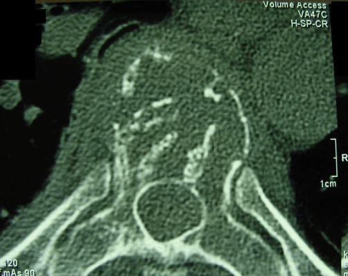 Single axial CT image through a vertebral body showing coarse thickened residual trabeculae scattered as discrete dots, the polka-dot appearance of a vertebral haemangioma, with a 1 cm scale bar.
