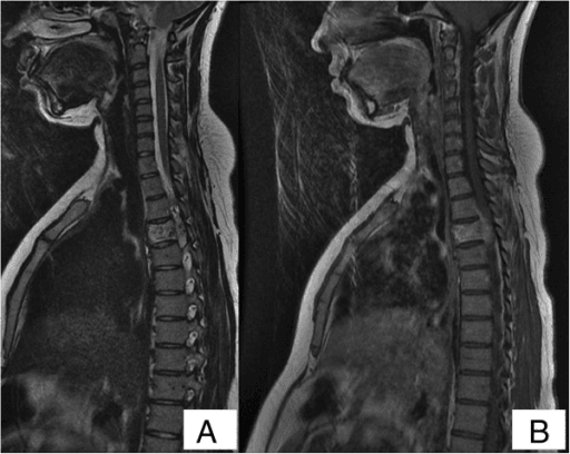 Two-panel sagittal MRI of the cervicothoracic spine showing a focal altered-signal vertebral lesion in the thoracic spine.