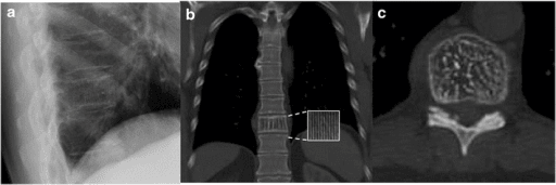 Three-panel study: lateral thoracic radiograph with vertical striations, coronal CT with magnified corduroy inset, and axial CT with polka-dot pattern.