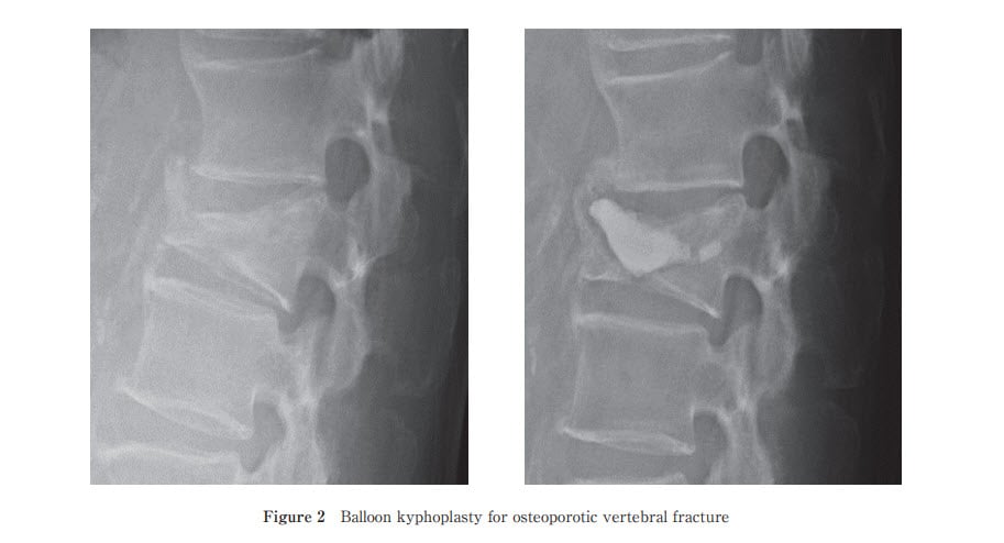 Lateral lumbar radiographs before and after balloon kyphoplasty showing PMMA cement filling a vertebral compression fracture.