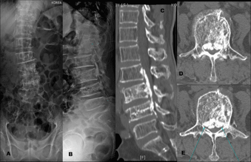 Post-kyphoplasty radiographs and CT showing epidural cement leakage through a violated medial pedicle wall with spinal-canal compression.