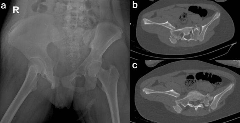 AP pelvic radiograph and axial CT of vertical shear pelvic ring injury