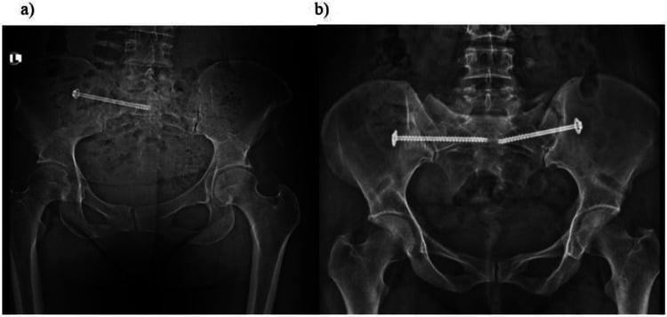 AP pelvic radiographs of a single sacroiliac screw from one side and of two screws, one from each side, meeting near the midline