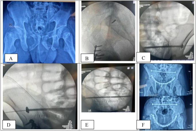 Preoperative radiograph, intraoperative fluoroscopy of guidewire and screw placement, and final films of a long posterior screw spanning both sacroiliac joints with an anterior plate