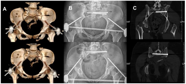 Postoperative 3D CT, radiographs and CT showing transverse posterior screws and an anterior external frame after sacral fracture fixation