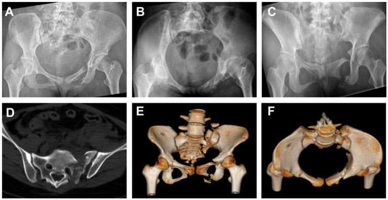 Displaced pelvic ring injury on three plain radiographs, an axial CT slice through the posterior ring and two 3D CT reconstructions