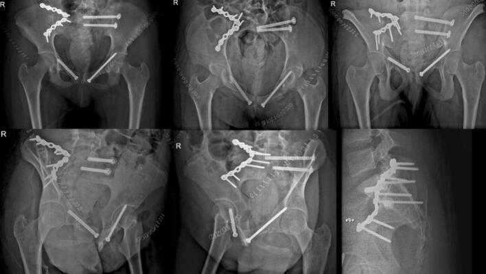 Postoperative pelvic trauma radiographs after vertical shear fixation