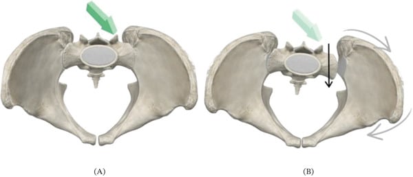 Schematic of vertical shear force mechanism on the posterior pelvic ring