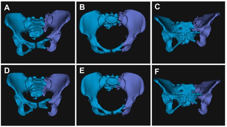 Patient-specific 3D pelvic models before and after planned reduction, each in three projections