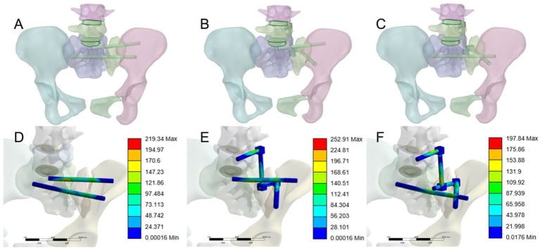 Finite-element models of three posterior pelvic constructs, transverse screws alone and with added vertical lumbopelvic rods, with their stress maps