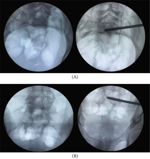 Two pairs of intraoperative fluoroscopic images before and after a partially threaded screw is passed from the lateral side into the sacrum