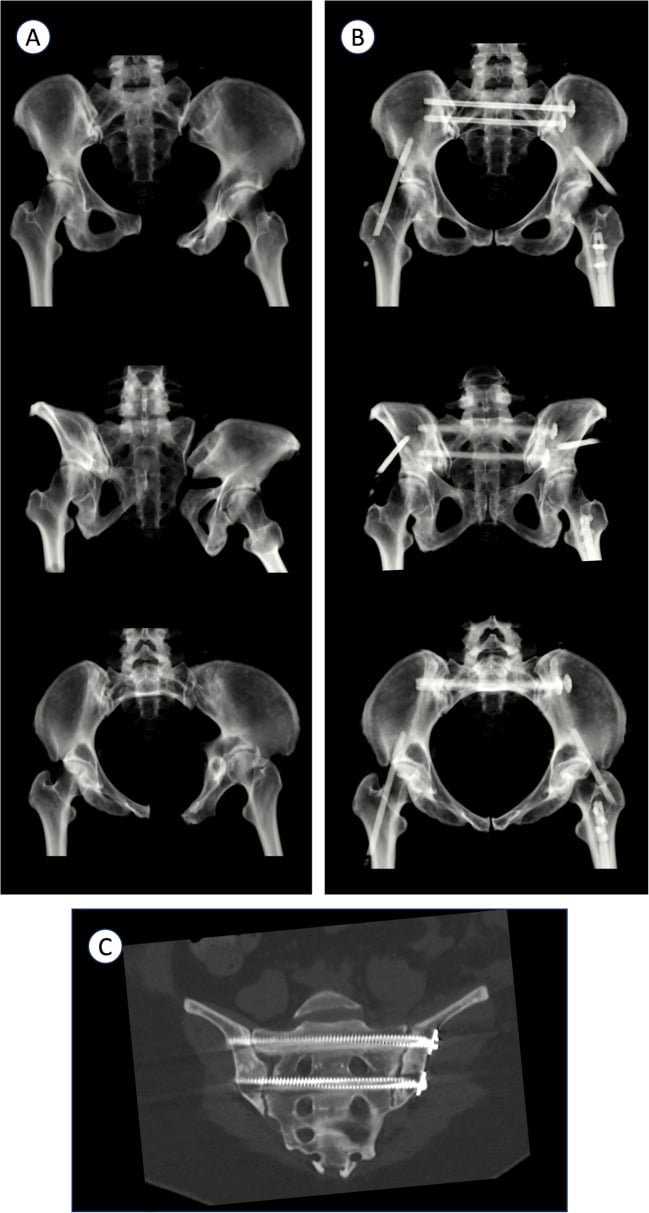 CT reconstructions of the pelvis before and after posterior screw fixation, and a CT slice along the sacrum showing two transverse screws crossing it clear of the foramina