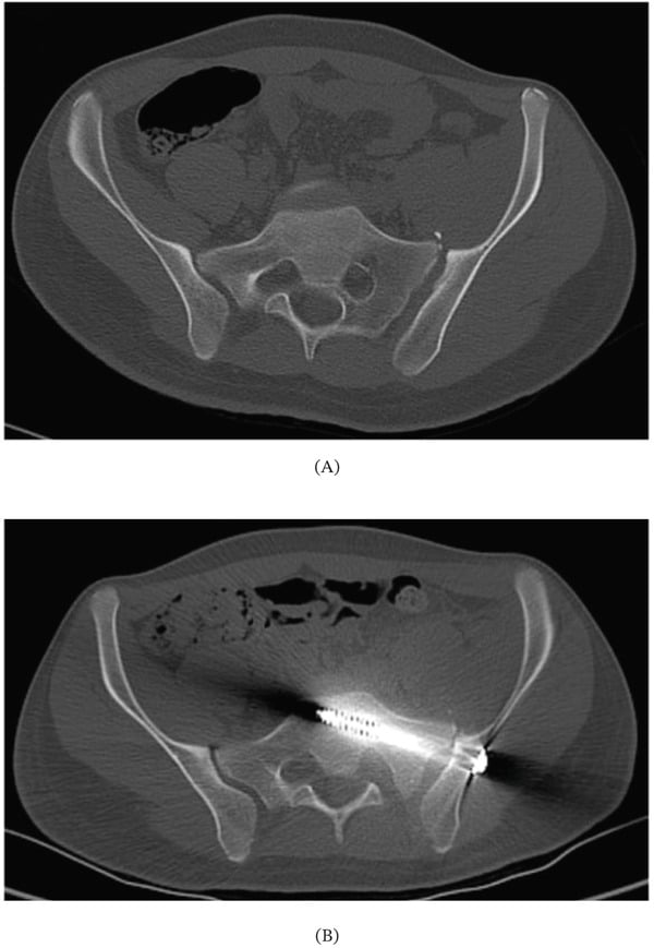 Axial CT before and after iliosacral fixation