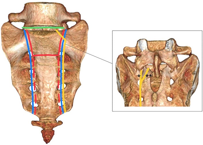 Anterior 3D CT view of the sacrum and L5 with coloured lines mapping vertical, transverse and lumbosacral fracture paths, and a posterior-view inset of a vertical fracture line reaching the L5-S1 facet region