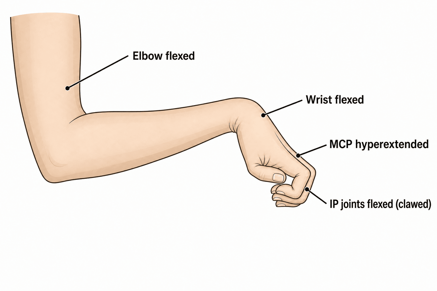 Labelled schematic of the classic Volkmann's ischemic contracture claw-hand posture
