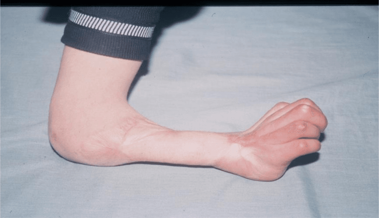 Clinical photograph of an established contracture with the wrist and fingers held flexed