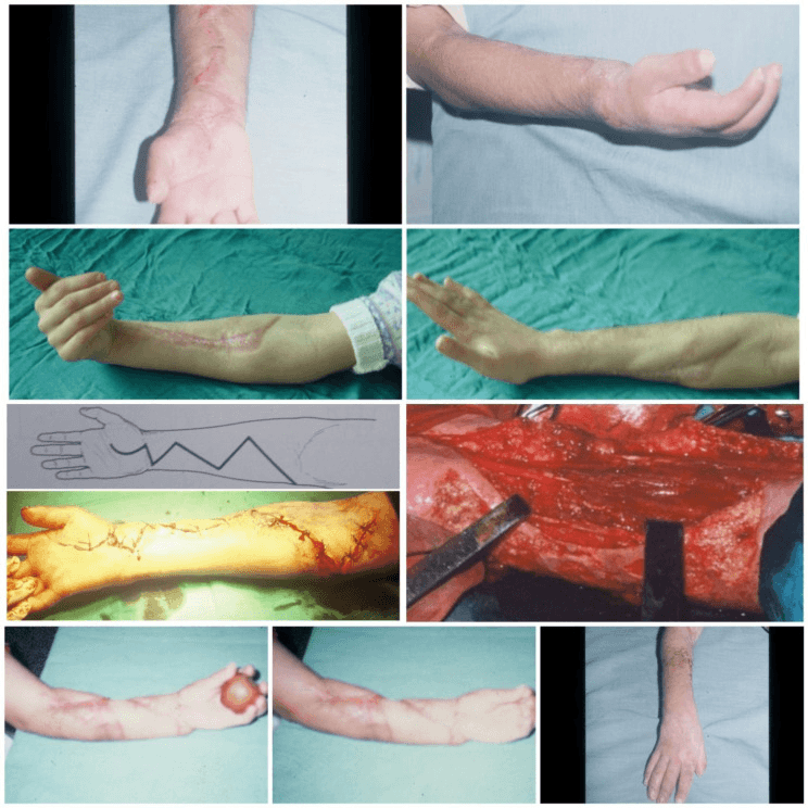 Clinical outcomes after fasciotomy neurolysis and tenolysis in severe Volkmann contracture