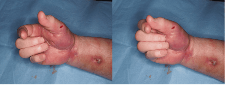 Two preoperative views of fixed finger flexion in Volkmann contracture