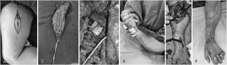 Functioning free gracilis transfer for restoration of finger flexion, panels A to F