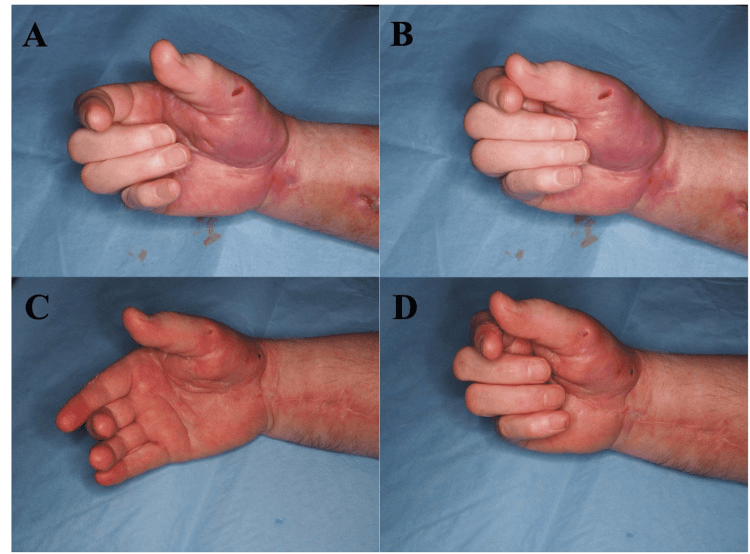 Finger extension and flexion before and three months after reconstruction