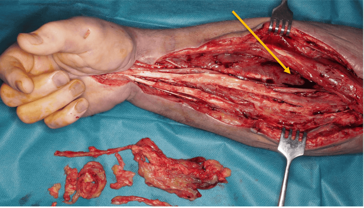 Extensile forearm exposure for median nerve neurolysis with excised tissue laid out below the limb