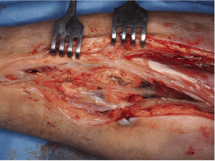 Operative view of a necrotic cavity deep in the forearm during debridement