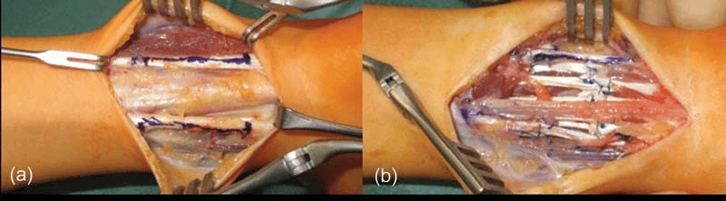 Two operative stages of forearm tendon release with the tendons marked in ink