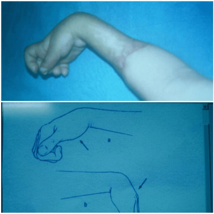 Contracted hand with line drawings showing finger posture changing with wrist position