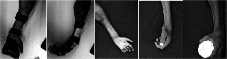 Postoperative orthoses and later grasp after functional muscle transfer