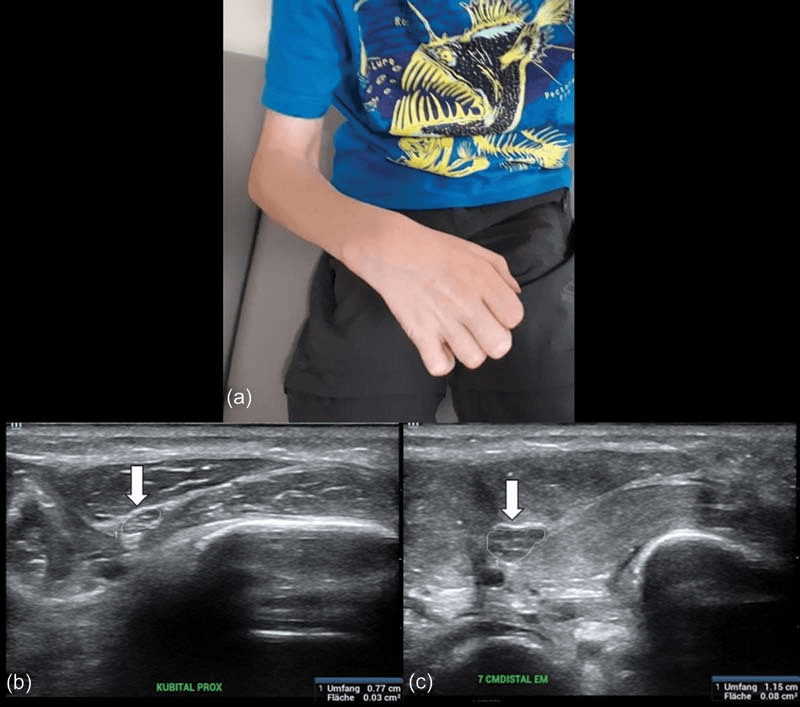 Volkmann hand posture with ulnar nerve ultrasound at two levels