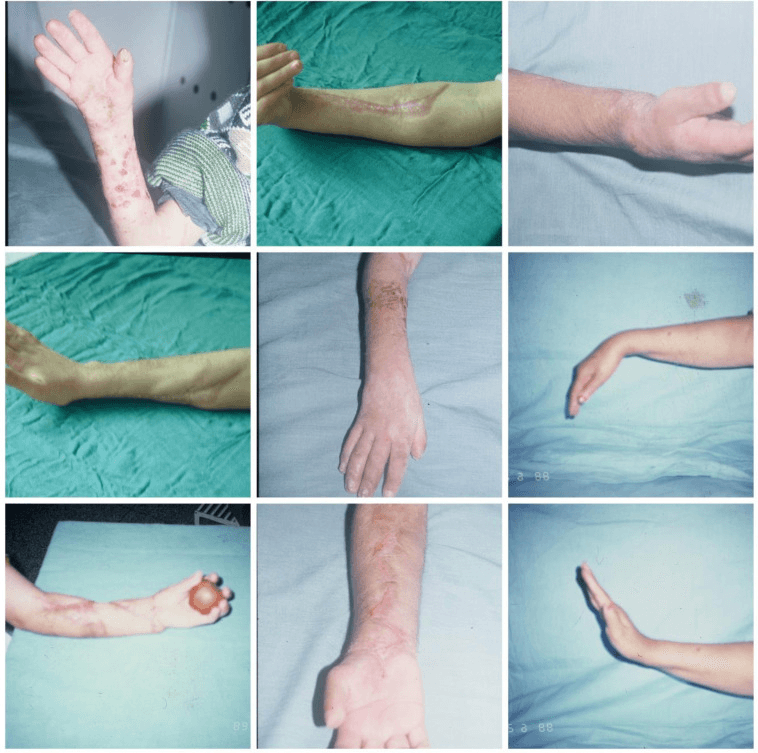 Postoperative forearm and hand photographs after reconstructive procedures for Volkmann contracture
