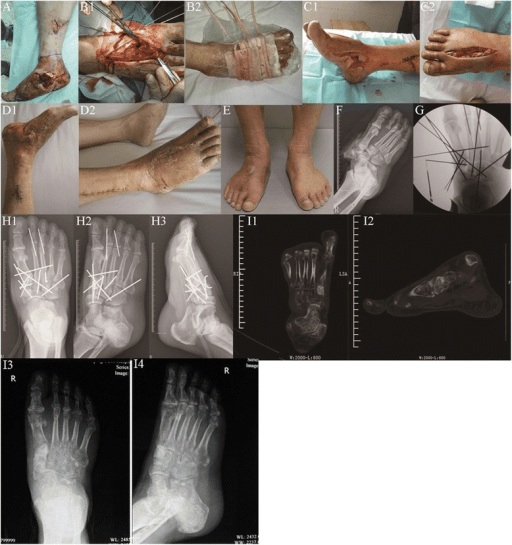 Cross-sectional imaging of complex Lisfranc injury relevant to load-dependent midfoot instability assessment.