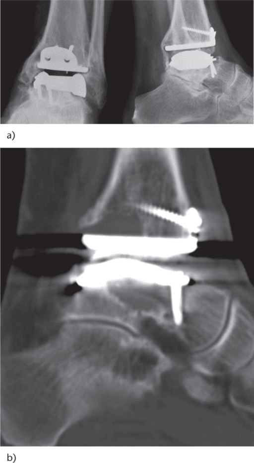 CT-based assessment of ankle arthroplasty position and peri-prosthetic bone change.