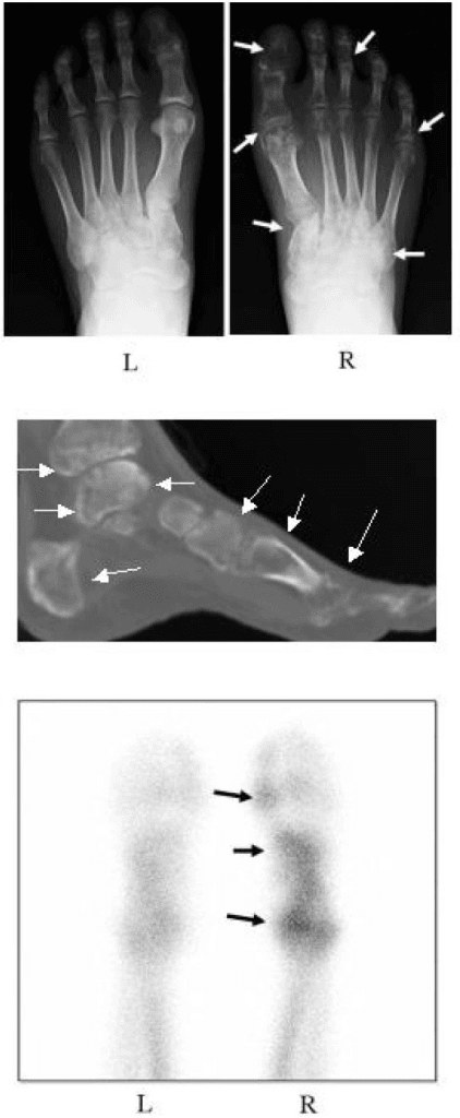 Radiograph and CT comparison of foot pathology showing the extra structural detail available on cross-sectional imaging.