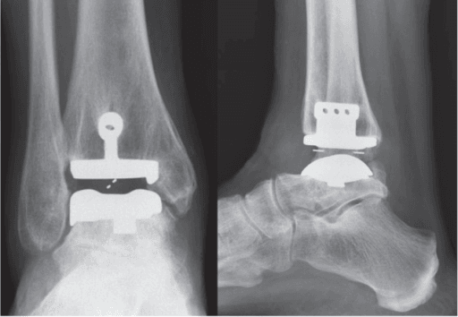 Ankle prosthesis alignment scenario relevant to post-operative CT assessment.