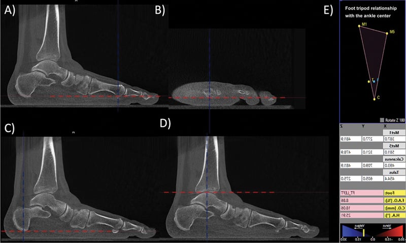 WBCT landmark panels A to D and software output panel E used to calculate Foot and Ankle Offset