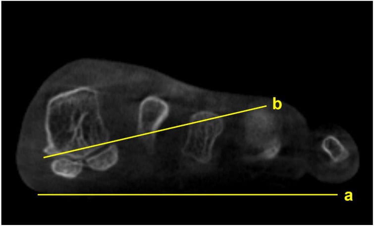 Cross-sectional WBCT through the forefoot with floor line a and sesamoid reference line b for first-metatarsal pronation