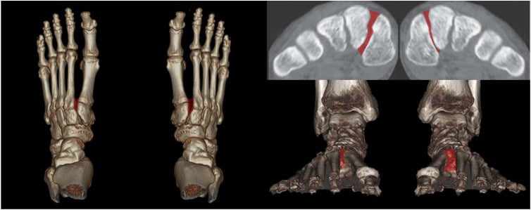 Three-dimensional WBCT segmentation and volumetric measurement of the Lisfranc interval