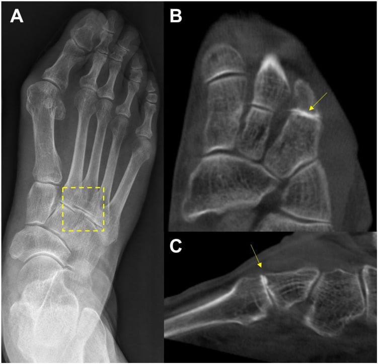 Foot radiograph with the midfoot boxed and WBCT slices with arrows at third tarsometatarsal osteoarthritis