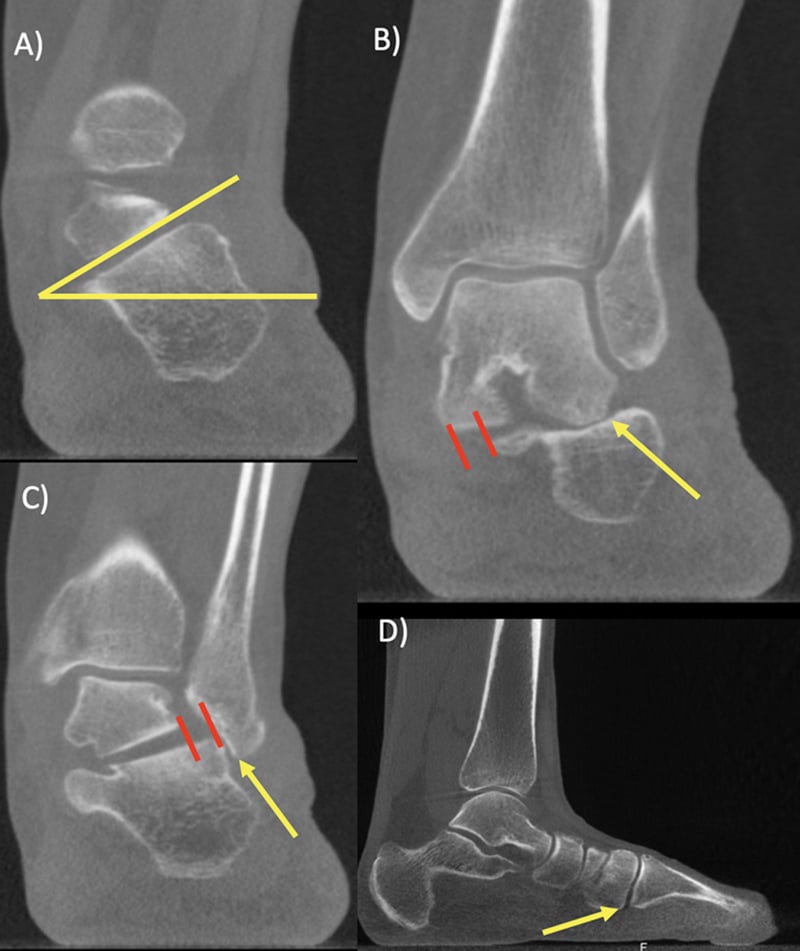WBCT panels A to D in progressive collapsing foot deformity: coronal hindfoot slices annotated with an angle, red lines and arrows, and a sagittal slice with an arrow at a midfoot joint
