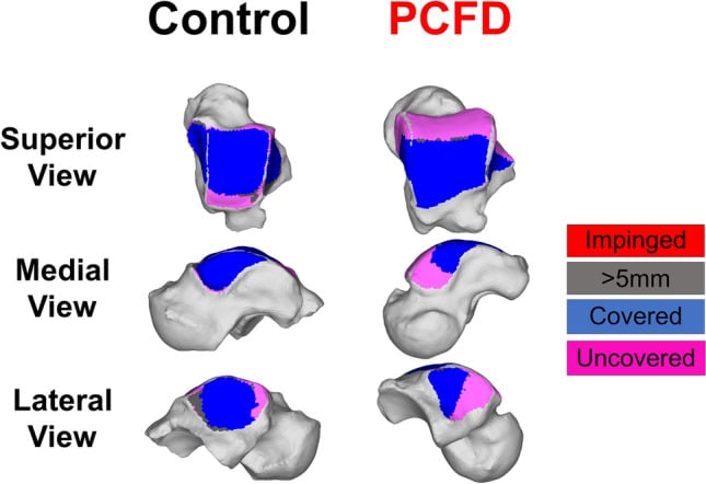 Three-dimensional talar coverage maps comparing a control foot with progressive collapsing foot deformity