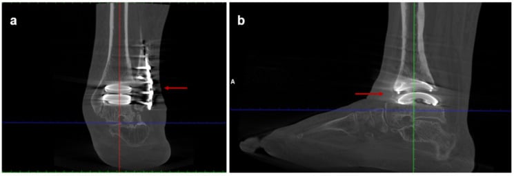 Three-year postoperative coronal and sagittal WBCT after total ankle replacement