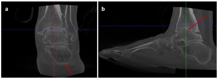 Preoperative coronal and sagittal WBCT of valgus ankle osteoarthritis with red arrows